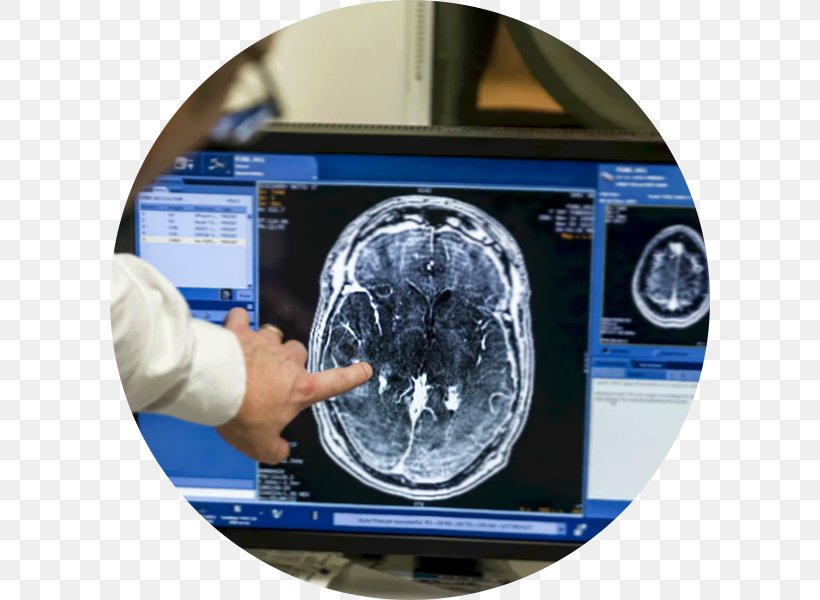 Blood–brain Barrier Scientist Cancer Surgery, PNG, 600x600px, Brain, Blood, Brain Tumor, Cancer, Cerebrum Download Free