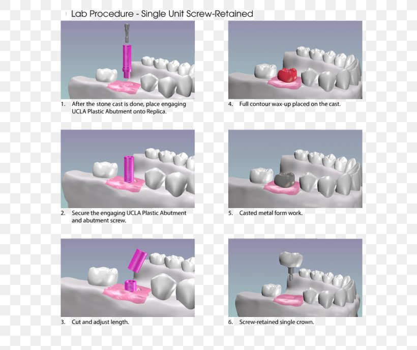 Abutment Dental Implant Dentistry, PNG, 650x688px, Abutment, Biomedical Engineering, Dental Implant, Dentistry, Implant Download Free