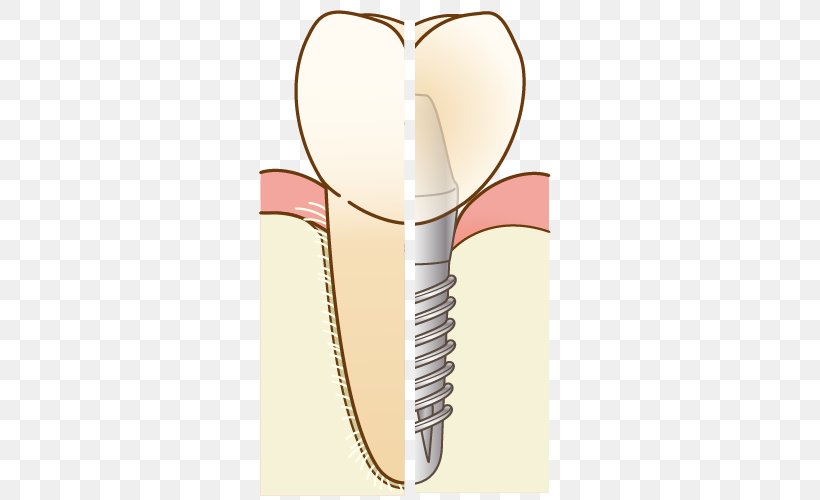 Dentist 歯科 Dental Implant Therapy Dentures, PNG, 500x500px, Watercolor, Cartoon, Flower, Frame, Heart Download Free