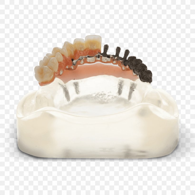 Tooth Dentistry Bridge Dentures Dental Implant, PNG, 940x940px, 3d Printing, 3d Systems, Tooth, Bridge, Dental Implant Download Free