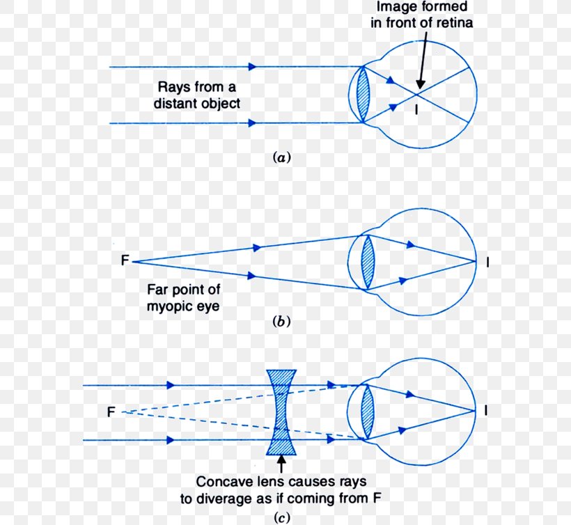 Near-sightedness Eye Lens Far-sightedness Cornea, PNG, 586x754px, Nearsightedness, Area, Blind Spot, Cornea, Diagram Download Free