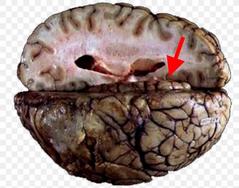 Brain Herniation Cerebellar Tentorium Tentorial Incisure Uncus Cingulate Gyrus, PNG, 1288x1016px, Brain Herniation, Anatomy, Brain, Cerebellar Tentorium, Cerebellar Tonsil Download Free
