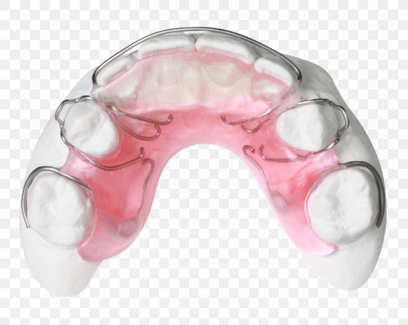 Gergen's Orthodontic Lab Orthodontic Technology Gergens Orthodontic Lab Orthodontics Bionator, PNG, 1024x817px, Orthodontic Technology, Bionator, Gergens Orthodontic Lab, Home Appliance, Jaw Download Free