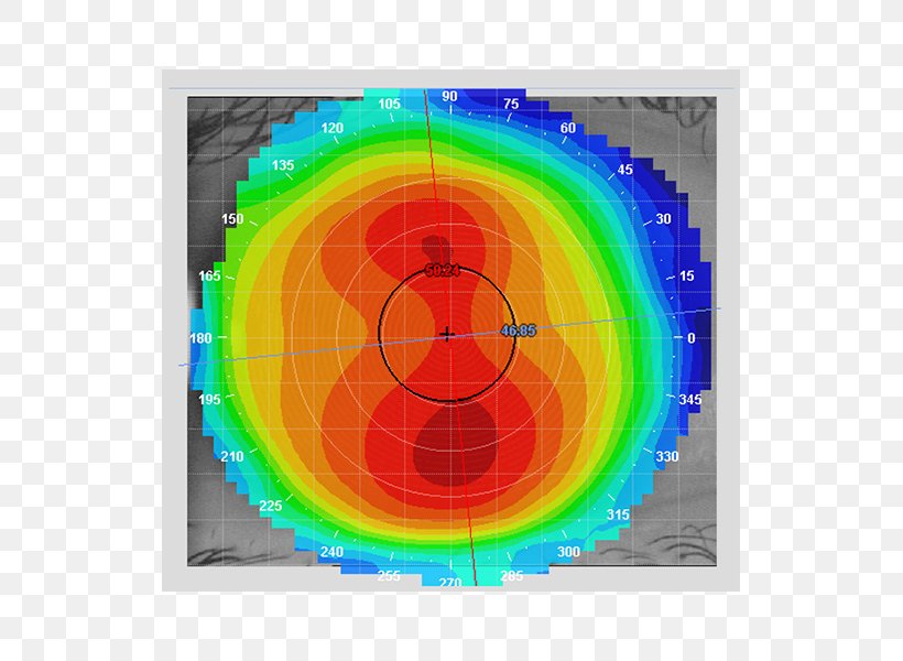 Corneal Topography Keratoconus Contact Lenses Optometry, PNG, 600x600px, Corneal Topography, Contact Lenses, Cornea, Curvature, Eye Download Free