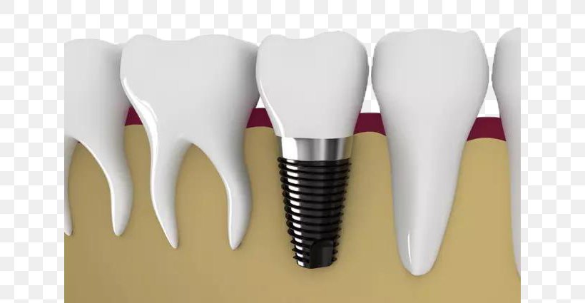 Dental Implant Dentistry Tooth Veneer Dental Restoration, PNG, 640x425px, Watercolor, Cartoon, Flower, Frame, Heart Download Free