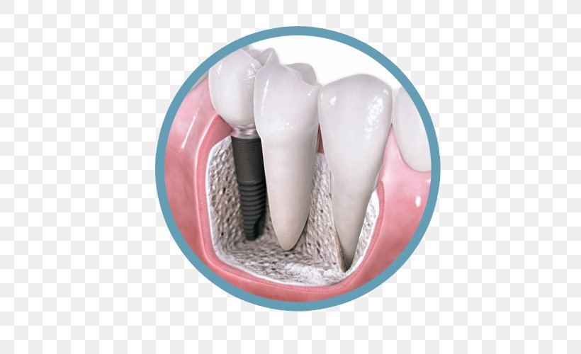 Dental Implant Dentistry Dental Surgery, PNG, 500x500px, Dental Implant, Cosmetic Dentistry, Crown, Dental Extraction, Dental Restoration Download Free