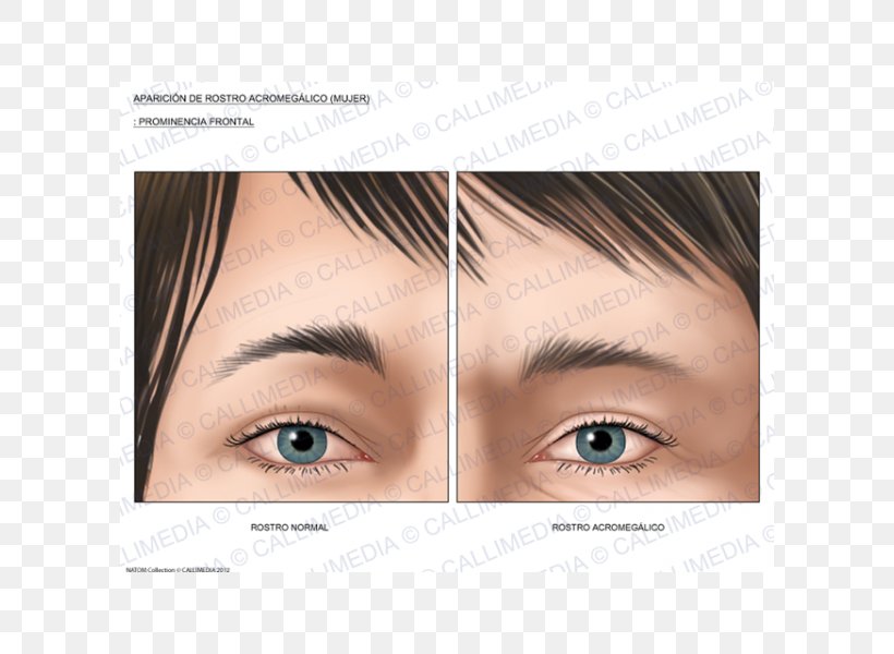 Skull Bossing Acromegaly Growth Hormone Symptom Forehead, PNG, 600x600px, Skull Bossing, Acromegaly, Cheek, Chin, Close Up Download Free