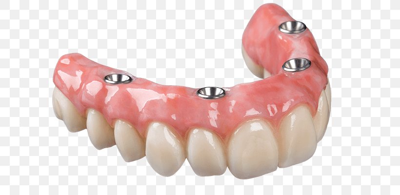 Dental Implant Dentures Removable Partial Denture Dental Prosthesis Dentistry, PNG, 800x400px, Dental Implant, Abutment, Bridge, Dental Prosthesis, Dental Restoration Download Free