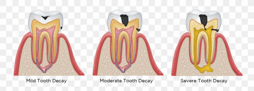 Tooth Decay Human Tooth Dentistry Dental Restoration, PNG, 1368x492px, Watercolor, Cartoon, Flower, Frame, Heart Download Free
