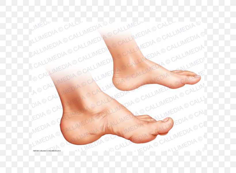 Toe Ankle Foot Podiatry Acromegaly, PNG, 600x600px, Watercolor, Cartoon, Flower, Frame, Heart Download Free
