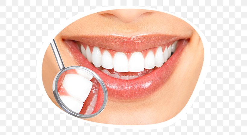 Tooth Whitening Cosmetic Dentistry Human Tooth, PNG, 595x450px, Tooth Whitening, Bridge, Chin, Cosmetic Dentistry, Crown Download Free