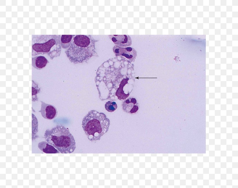 Macrophage Body Fluid Pleural Effusion Hemosiderin, PNG, 601x649px, Macrophage, Amorphous Solid, Body Fluid, Clinical Urine Tests, Effusion Download Free