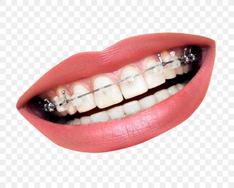 Dental Braces Dentistry Orthodontics Tooth Clear Aligners, PNG, 1933x1558px, Dental Braces, Clear Aligners, Crown, Dental Implant, Dental Surgery Download Free
