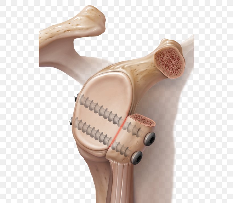 Latarjet Procedure Shoulder Surgery Dislocated Shoulder, PNG, 548x713px, Surgery, Arthroscopy, Bankart Lesion, Coracoid Process, Dislocated Shoulder Download Free
