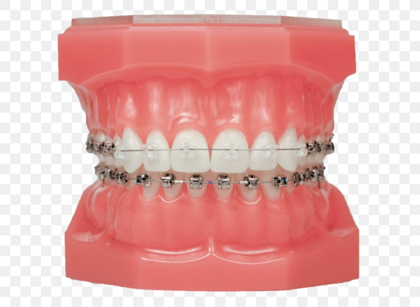 Damon System Dental Braces Clear Aligners Orthodontics Self-ligating Bracket, PNG, 648x600px, Damon System, Clear Aligners, Clinic, Cosmetic Dentistry, Dental Braces Download Free