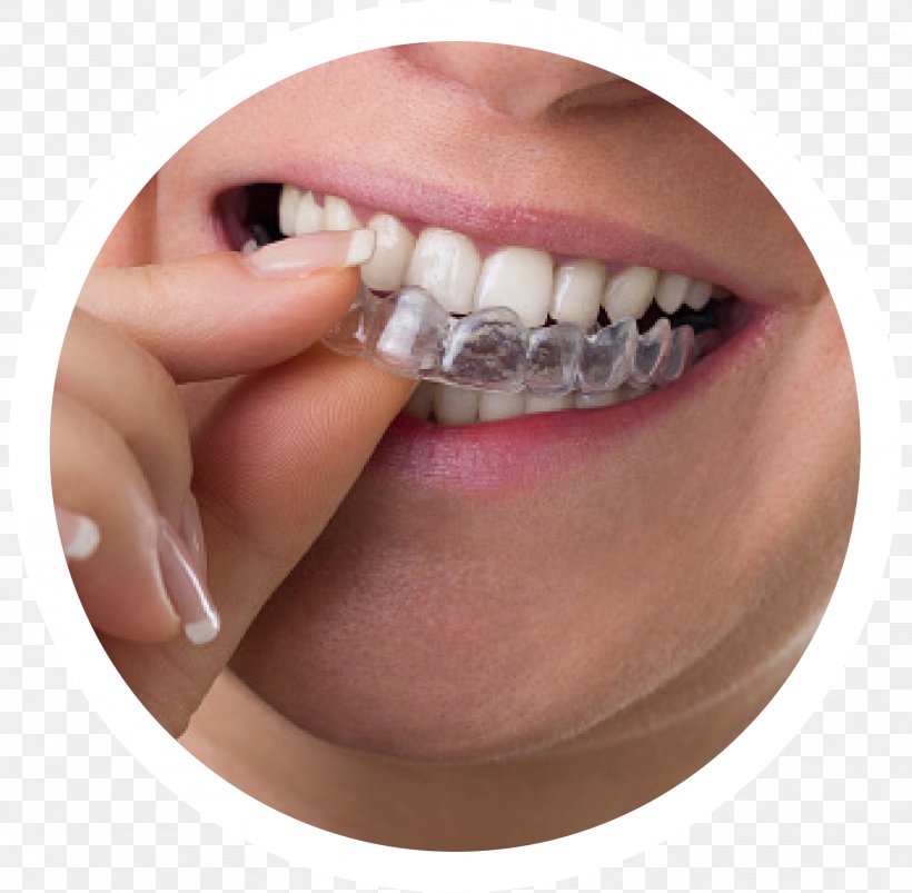Clear Aligners Dental Braces Dentistry Orthodontics Tooth, PNG, 1813x1776px, Clear Aligners, Cosmetic Dentistry, Dental Braces, Dental Insurance, Dentist Download Free