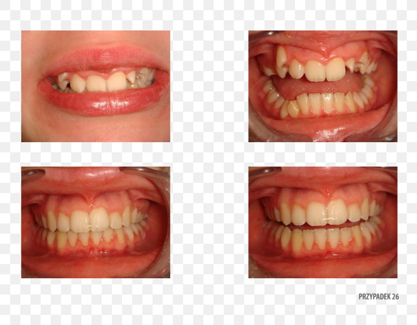Tooth Orange Polska Close-up Therapy, PNG, 1024x800px, Tooth, Chin, Close Up, Closeup, Cosmetic Dentistry Download Free