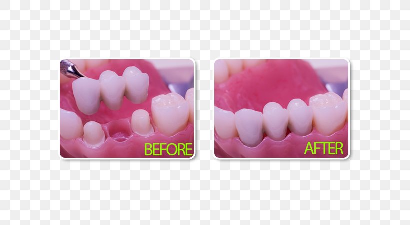 Bridge Dentistry Dental Implant Crown, PNG, 600x450px, Bridge, Crown, Dental Implant, Dental Restoration, Dental Surgery Download Free