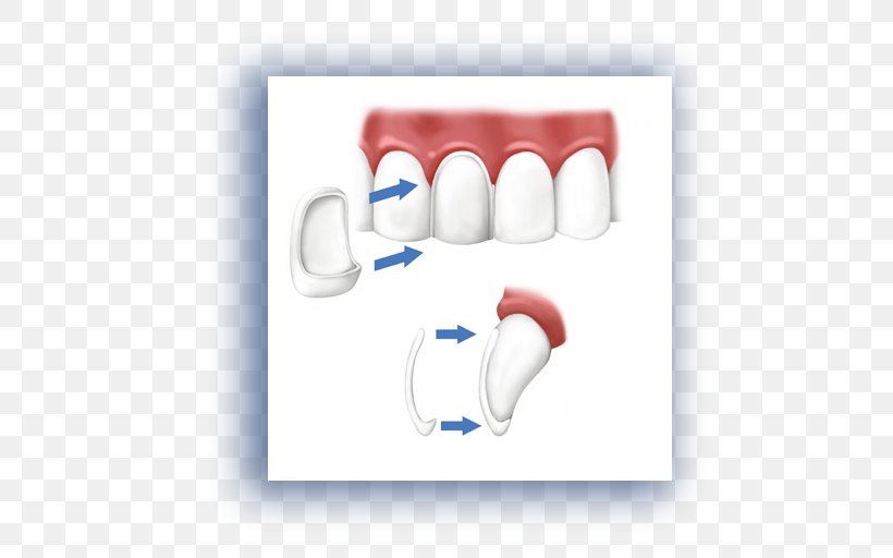 Veneer Cosmetic Dentistry Crown, PNG, 512x512px, Veneer, Cosmetic Dentistry, Crown, Dental Composite, Dental Implant Download Free