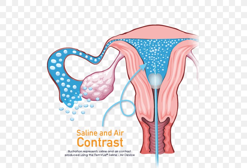 Fallopian Tube Ultrasonography Infertility Uterus Hysterosalpingography, PNG, 510x557px, Watercolor, Cartoon, Flower, Frame, Heart Download Free