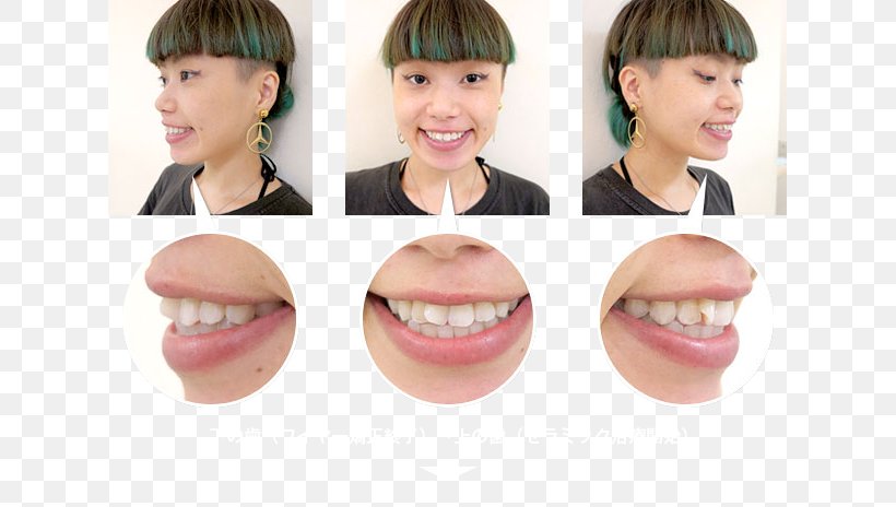 Lip Cheek Mouth Chin Jaw, PNG, 621x464px, Lip, Beautym, Cheek, Chin, Cosmetic Dentistry Download Free