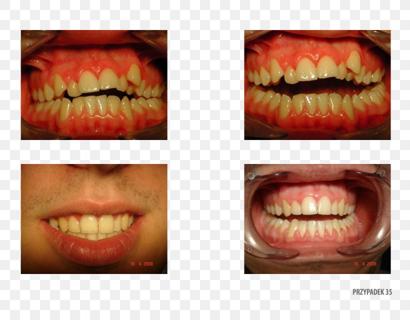 Tooth Gingivoplasty Camera Gums Ortoprotex, PNG, 1024x800px, Tooth, Camera, Cheek, Chin, Clinic Download Free