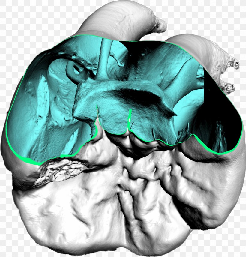 Dentistry Computed Tomography Dental Impression, PNG, 1200x1255px, Watercolor, Cartoon, Flower, Frame, Heart Download Free