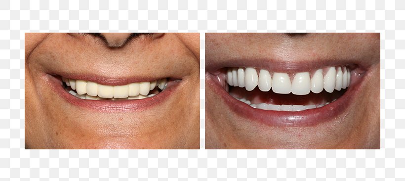Tooth All-on-4 Dental Implant Dentures, PNG, 720x366px, Tooth, Cheek, Chin, Close Up, Cosmetic Dentistry Download Free