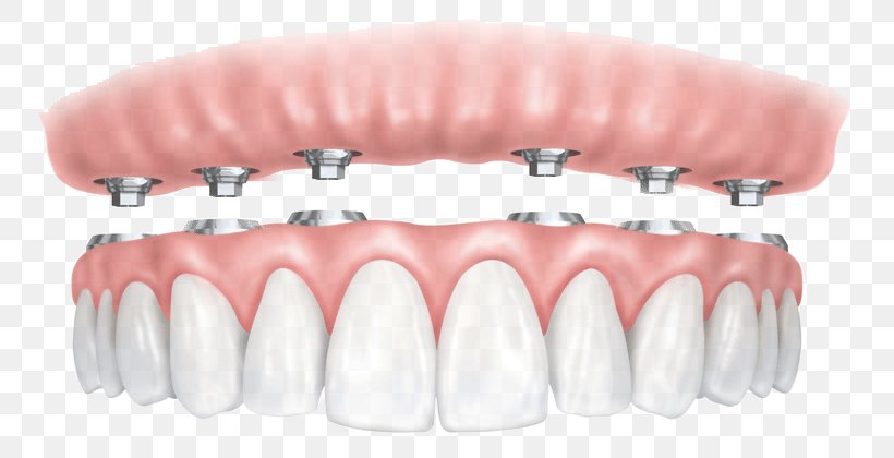 All-on-4 Dental Implant Dentures Dentistry, PNG, 792x420px, Dental Implant, Dental Restoration, Dentistry, Dentures, Doctor Of Medicine Download Free
