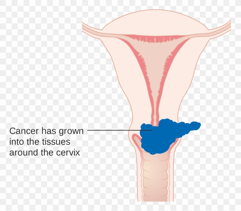 Cervical Cancer Staging Cervix, PNG, 1600x1408px, Watercolor, Cartoon, Flower, Frame, Heart Download Free