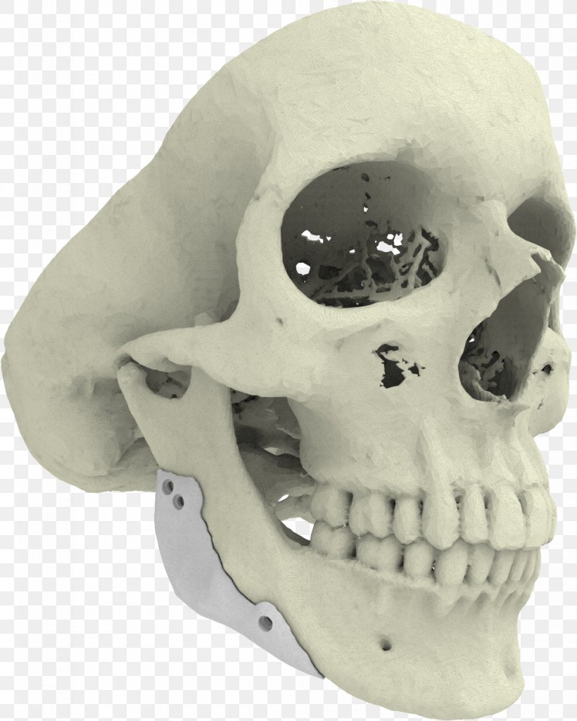 3D Printing Implant Xilloc Bone, PNG, 991x1238px, 3d Printing, Bone, Bone Grafting, Computed Tomography, Head Download Free