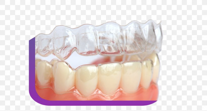 Clear Aligners Dental Braces Dentistry Tooth Orthodontics, PNG, 973x525px, Clear Aligners, Dental Braces, Dental Restoration, Dentin Hypersensitivity, Dentist Download Free