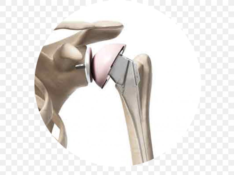 Shoulder Replacement Shoulder Surgery Joint Replacement, PNG, 1024x766px, Shoulder Replacement, Arthroplasty, Arthroscopy, Hip, Hip Replacement Download Free