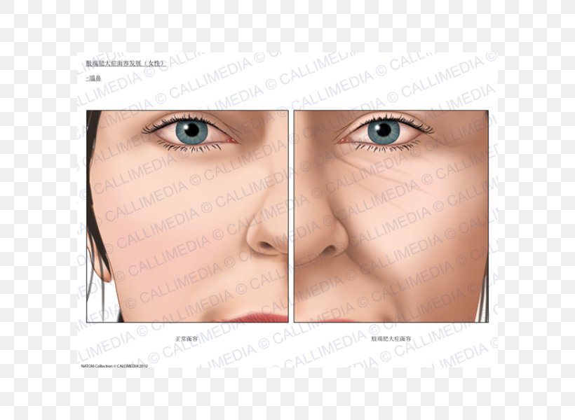 Acromegaly Nose Face Endocrinology Growth Hormone, PNG, 600x600px, Acromegaly, Blood Sugar, Cheek, Chin, Close Up Download Free