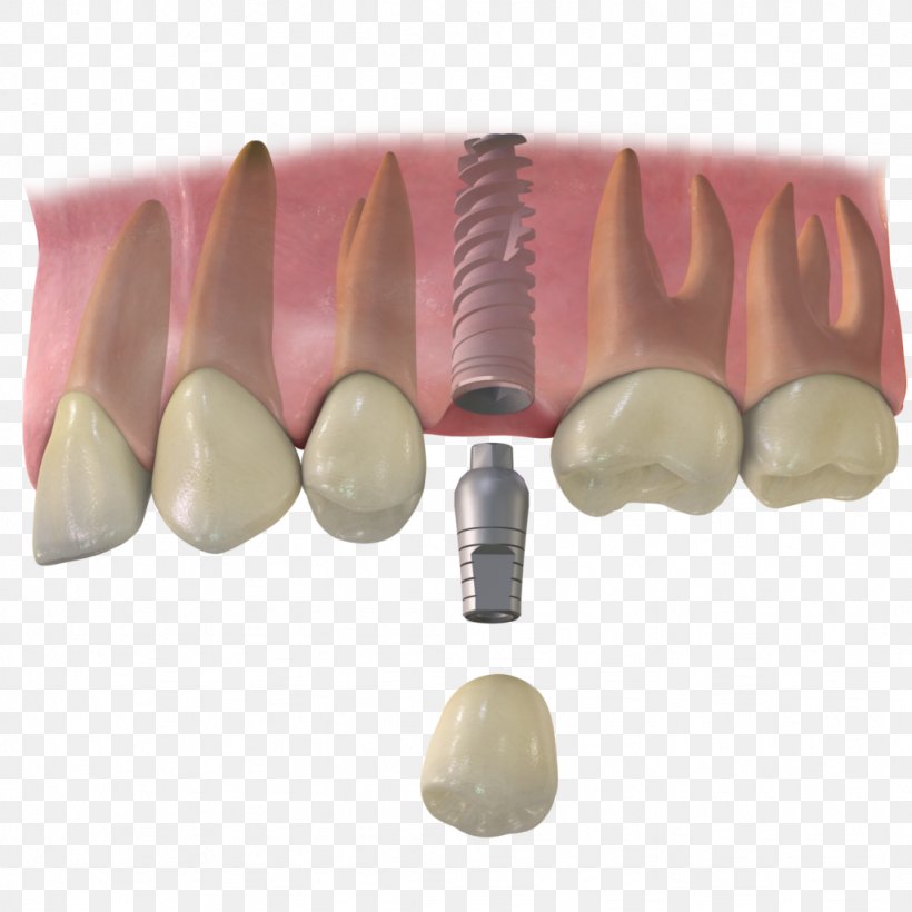 Tooth Dental Implant Dentistry Implantology, PNG, 1024x1024px, Tooth, Crown, Dental Extraction, Dental Implant, Dentist Download Free
