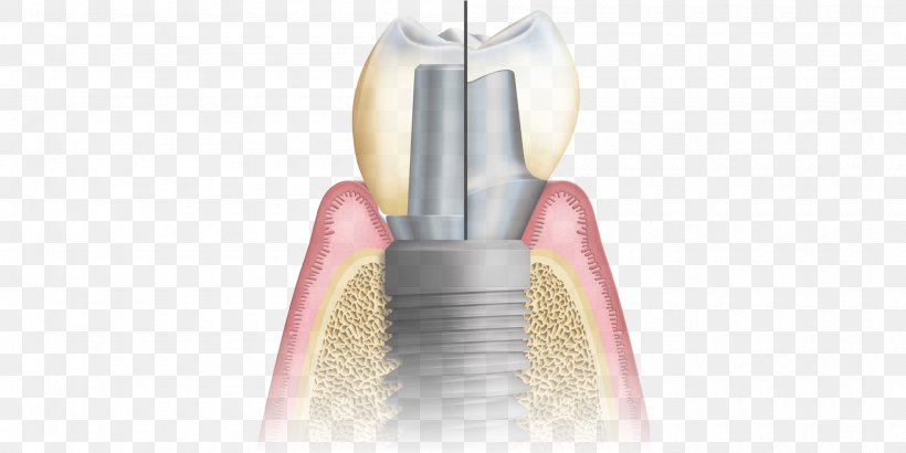 Abutment Dental Implant CAD/CAM Dentistry Implantology, PNG, 2000x1000px, Abutment, Bisphosphonate, Cadcam Dentistry, Cosmetic Dentistry, Dental Implant Download Free