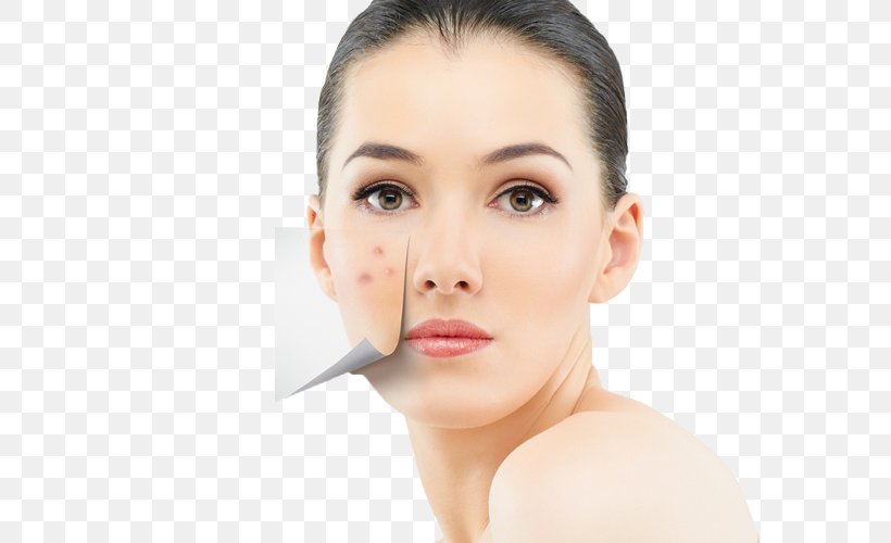 Skin Care Health Acne Diet, PNG, 750x500px, Skin, Acne, Beauty, Cheek, Chin Download Free