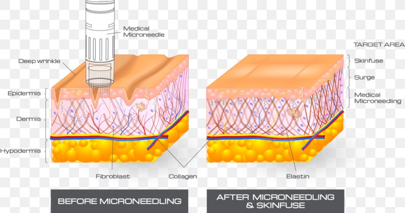 Collagen Induction Therapy Human Skin Skin Care, PNG, 1024x540px, Watercolor, Cartoon, Flower, Frame, Heart Download Free