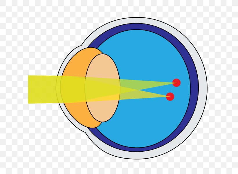 Astigmatism Cornea Eye Disease Near-sightedness, PNG, 725x600px, Astigmatism, Contact Lenses, Cornea, Disease, Eye Download Free