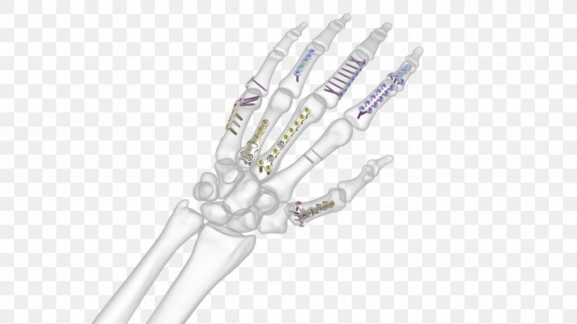 Hand Bone Fracture Synthes Metacarpal Bones Anatomy, PNG, 4000x2250px, Hand, Anatomy, Body Jewelry, Bone, Bone Fracture Download Free