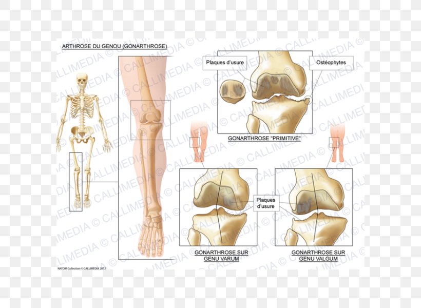 Knee Osteoarthritis Knee Osteoarthritis Knee Arthritis, PNG, 600x600px, Watercolor, Cartoon, Flower, Frame, Heart Download Free