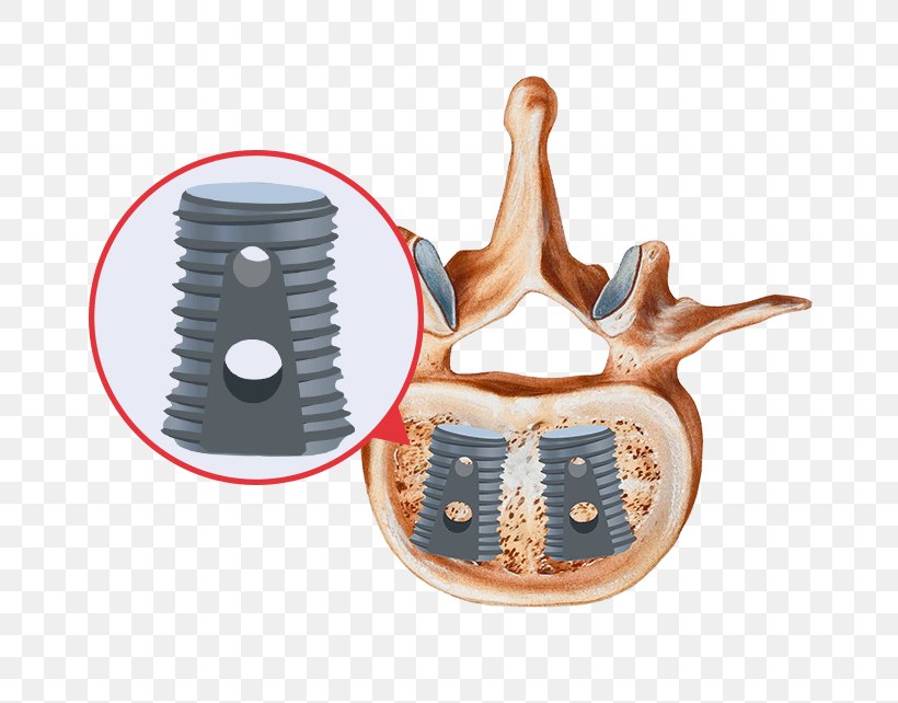 Bone Grafting Spinal Fusion Bone Morphogenetic Protein Implant, PNG, 675x642px, Bone Grafting, Bone, Bone Morphogenetic Protein, Cervical Vertebrae, Dental Implant Download Free