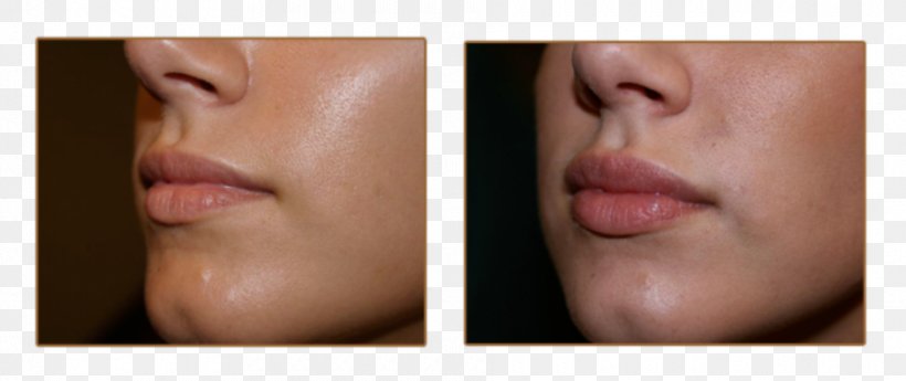 Lip Augmentation Injectable Filler Juvéderm Cheek, PNG, 940x396px, Lip, Cheek, Chin, Close Up, Dermis Download Free