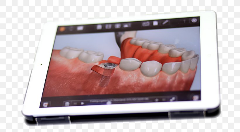 IPad 2 Netbook Dentist Implantology Dental Implant, PNG, 750x451px, Ipad 2, Apple, Dental Implant, Dentist, Dentures Download Free