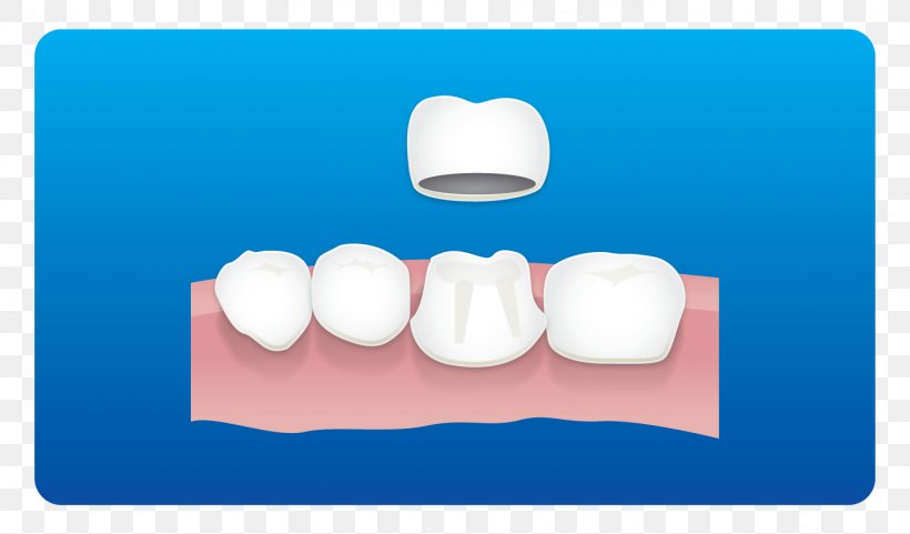 Tooth Dental Implant Root Canal Dentist Dental Restoration, PNG, 1421x835px, Tooth, Dental Braces, Dental Care, Dental Implant, Dental Restoration Download Free