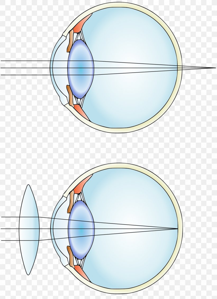 Near-sightedness Hypermetropia Corrective Lens Astigmatism Refractive Surgery, PNG, 1200x1657px, Nearsightedness, Amblyopia, Area, Astigmatism, Color Blindness Download Free
