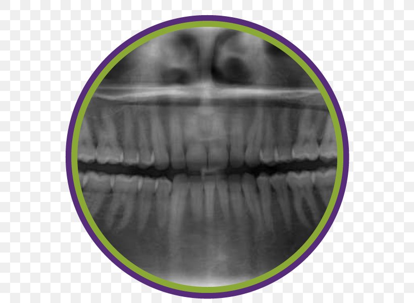 Dentistry Periodontal Disease Tooth Periodontosis Dental Radiography, PNG, 600x600px, Dentistry, Dental Braces, Dental Radiography, Dental Restoration, Gums Download Free