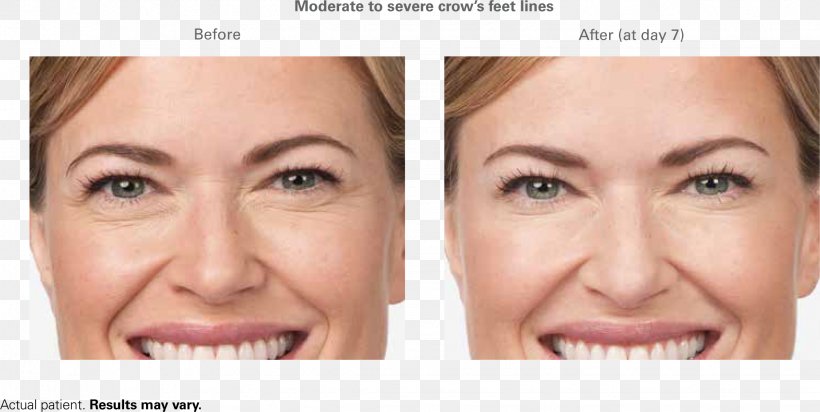 Botulinum Toxin Wrinkle Frown Forehead Injectable Filler, PNG, 2247x1131px, Botulinum Toxin, Cheek, Chin, Close Up, Cosmetics Download Free