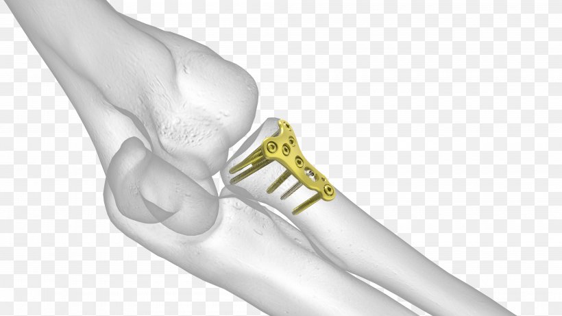 Thumb Elbow Radius Humerus Joint, PNG, 4000x2250px, Thumb, Arm, Arthroplasty, Body Jewelry, Bone Download Free