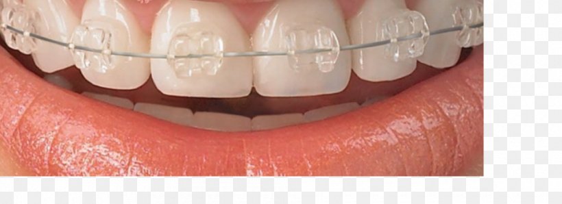 Damon System Weber Orthodontics Dental Braces Dentistry, PNG, 960x350px, Watercolor, Cartoon, Flower, Frame, Heart Download Free